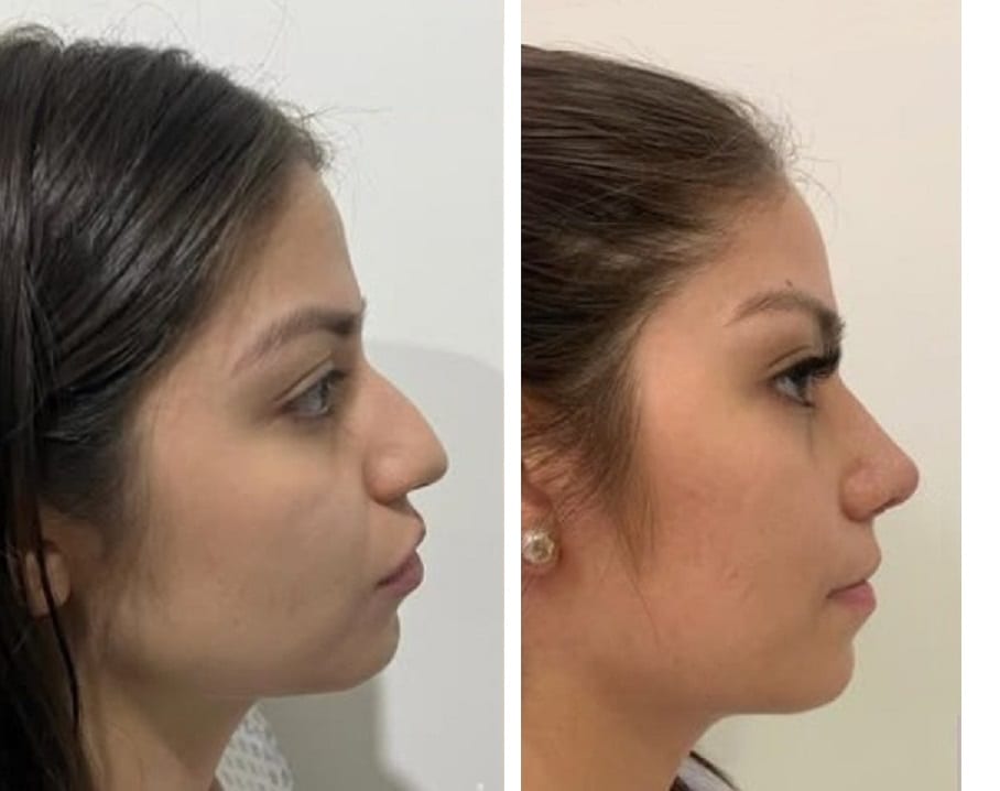 Rinoplastia caso 27 — antes y después